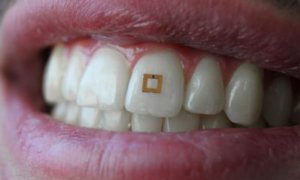 tooth sensor calorie counter tech for weight loss