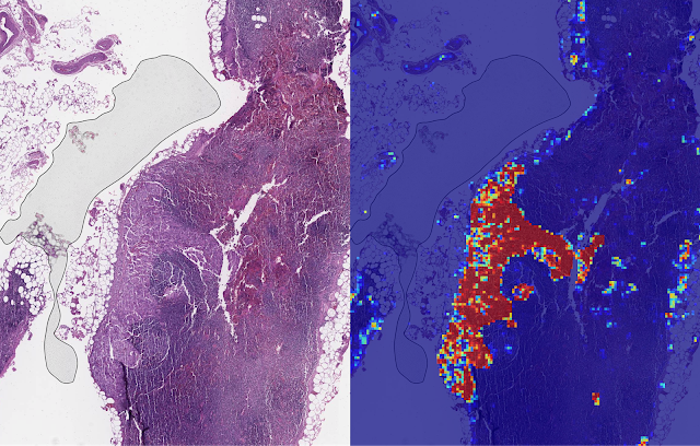 google-ai-creates-lyna-to-detect-breast-cancer-tumor